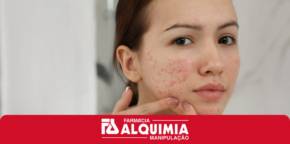Como Combater a Acne? Confira os Melhores Tratamentos Tópicos e Orais