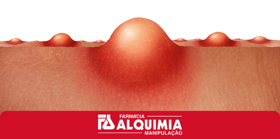 Como Combater a Acne? Confira os Melhores Tratamentos Tópicos e Orais