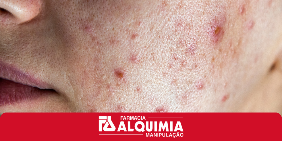 Como Combater a Acne? Confira os Melhores Tratamentos Tópicos e Orais